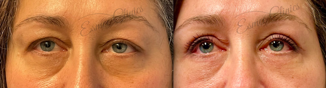 Before and After img